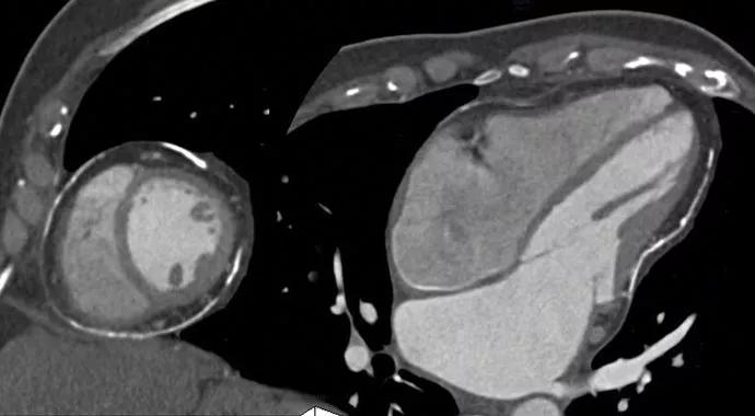 Pericarditis-690&#215;380