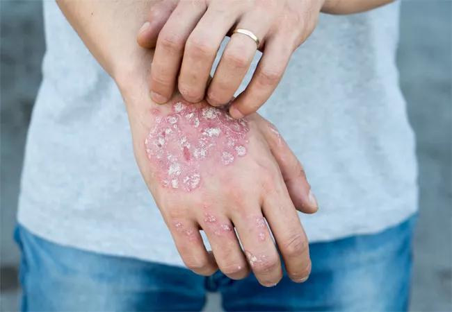 psoriatic arthritis