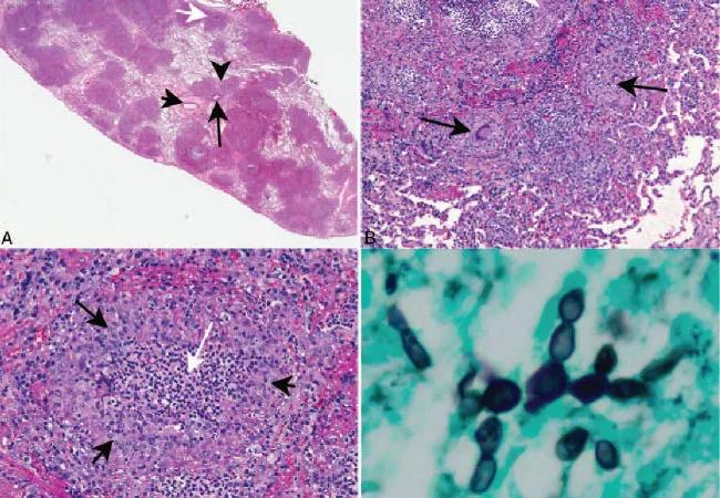 18-PTH-1115-Candida-Pneumonia-650&#215;450