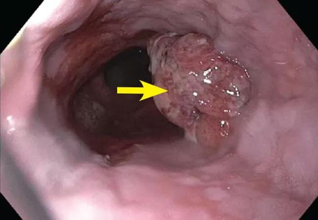 22-HVI-3042609_esophageal-adenocarcinoma_650x450