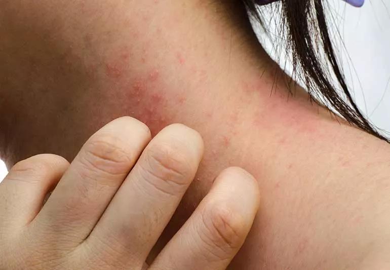 person scratching neck that has eczema