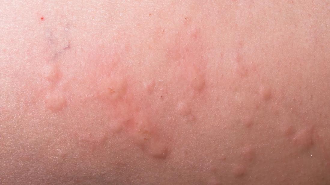 Close-up of rash on skin