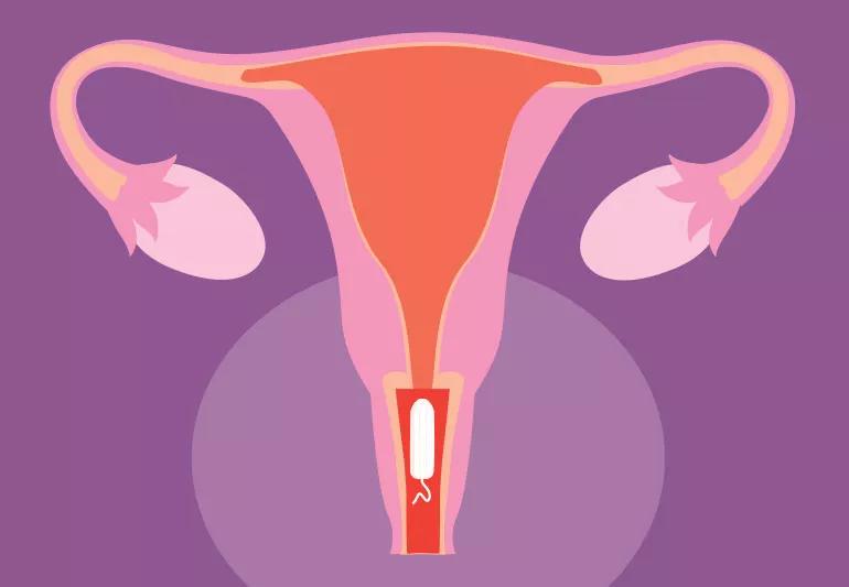 Drawing of female reproductive anotomy with a tampon in vagina.