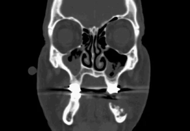 Osteoradionecrosis Scan