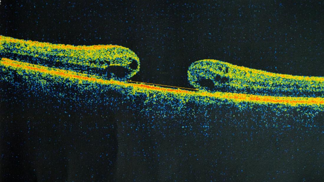 Macular hole