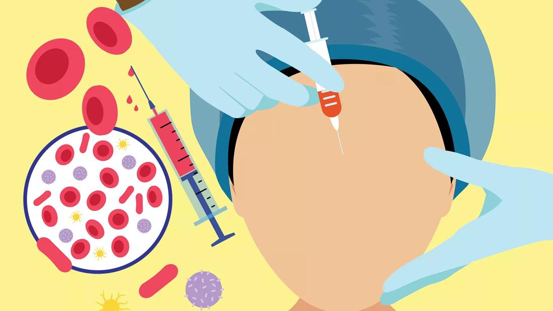 Illustration showing a needle injection into a person's forehead during a medical procedure