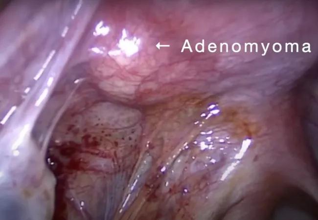adenomyoma