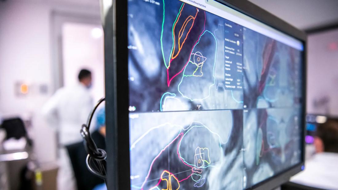 deep brain stimulation of dentate nucleus