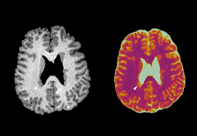 brain scan epilepsy