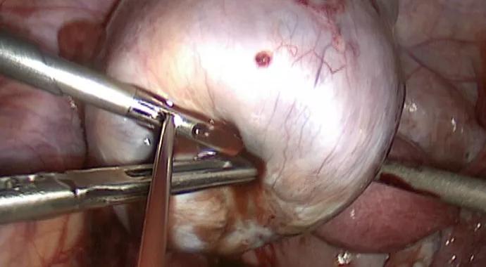 Endometrioma-690&#215;380