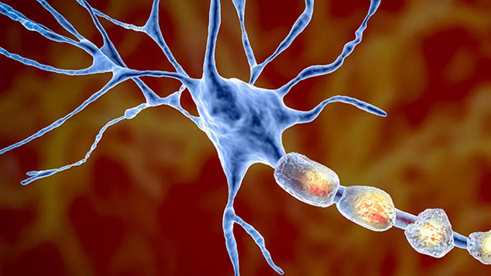 illustration of a neuron affected by multiple sclerosis