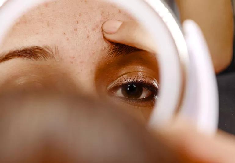 Clseup of person examining pimply skin in mirror.