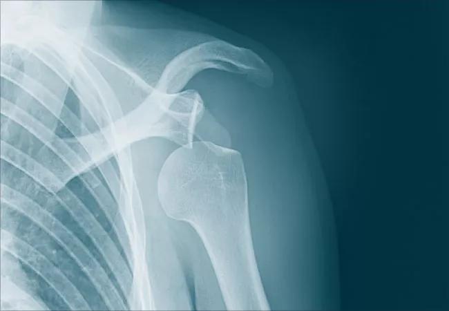 X-ray visual of a shoulder dislocation.