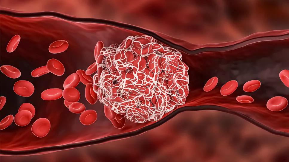 medical illustration of thrombosis