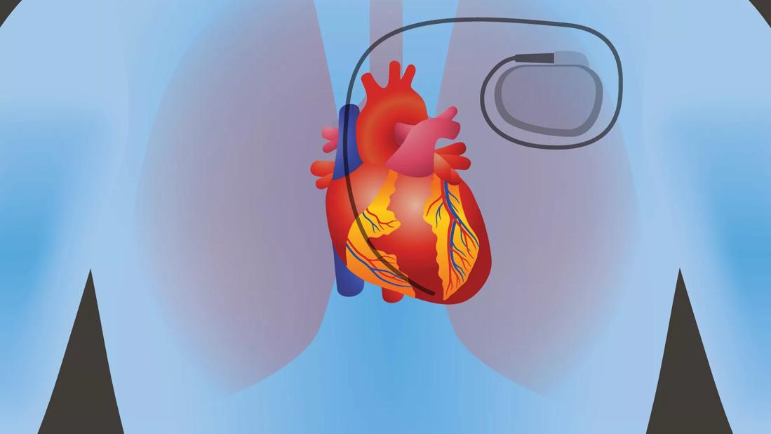 Pacemaker
