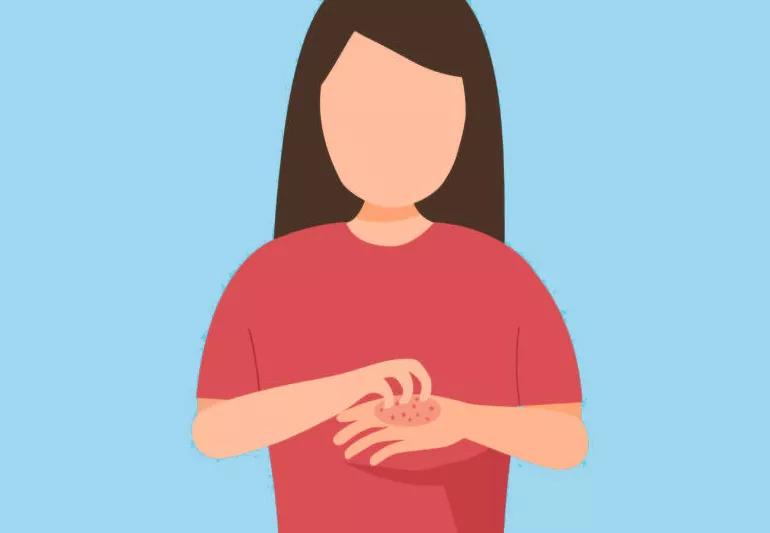 An illustration of a person scratching an itchy, inflamed spot on their hand