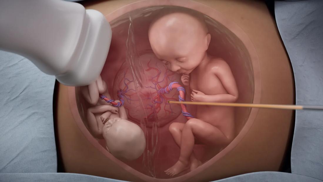 Illustration of small and large fetuses in patient with twin to twin transfusion syndrome