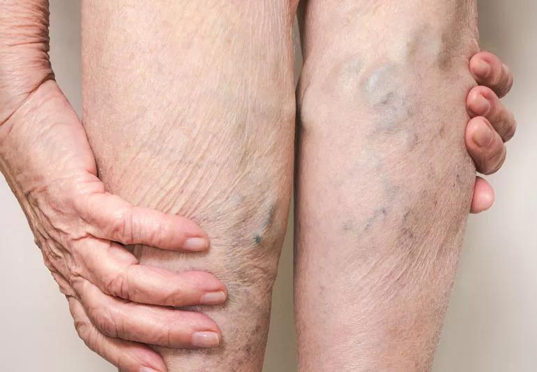 Woman messages the vericose veins in her legs