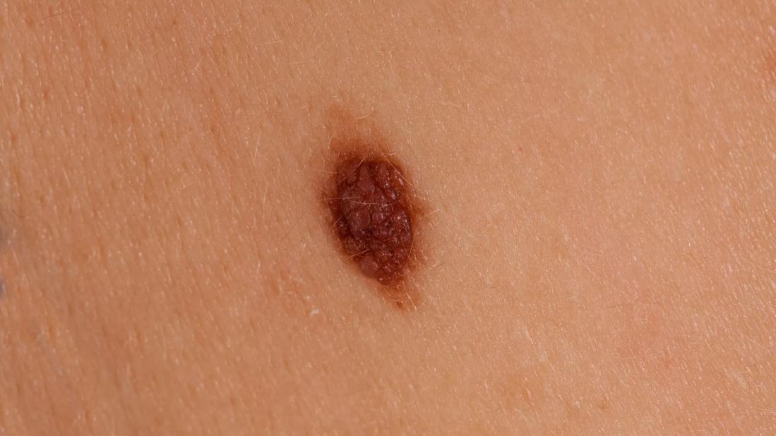 Can Melanoma Cancer Come Back?