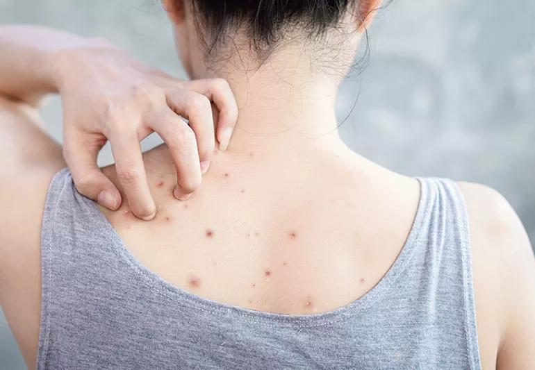 Person touching back with acne.