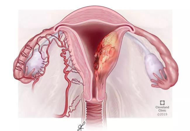 uterine leiomyosarcoma