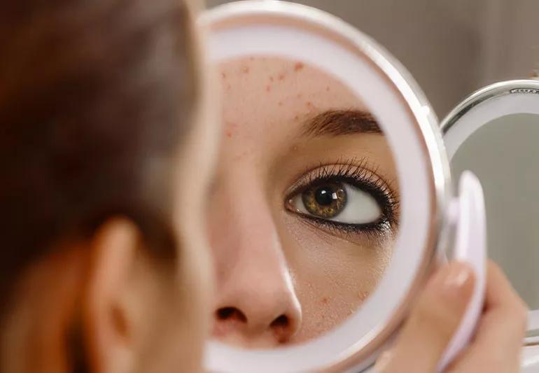Person using mirror to inspect pimples close up.