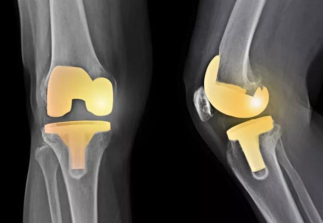 Total knee arthroplasty