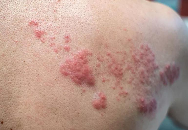 Shingles present on a shoulder of a light skinned person.