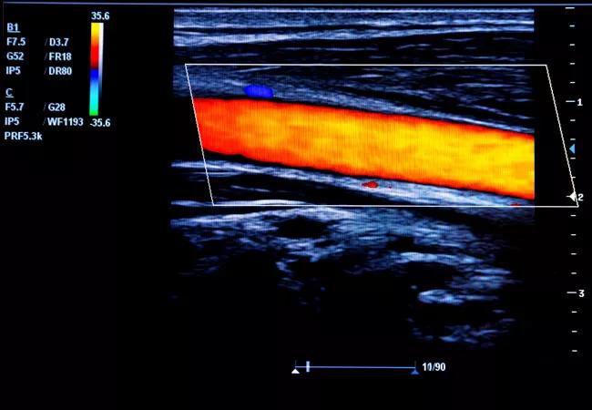 Ultrasound image of the carotid artery