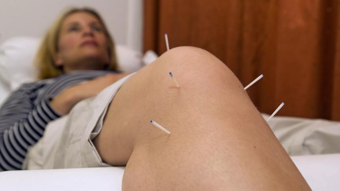 Knee Arthritis Got You Down? Acupuncture Can Bring Relief