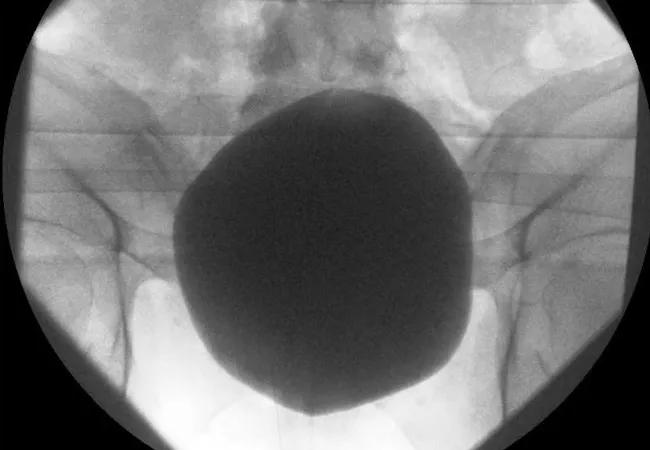 cystogram-smooth-bladder_650x450