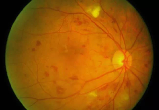 19-EYE-4245-Non-Proliferative-Diabetic-Retinopathy-CQD