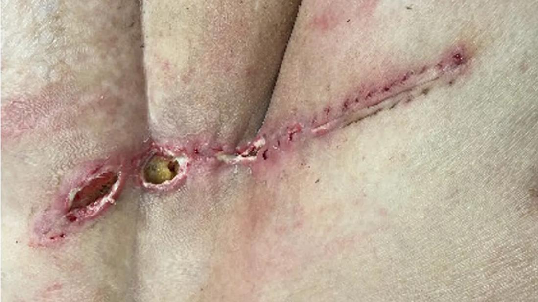 Incision after surgery to remove sarcoma