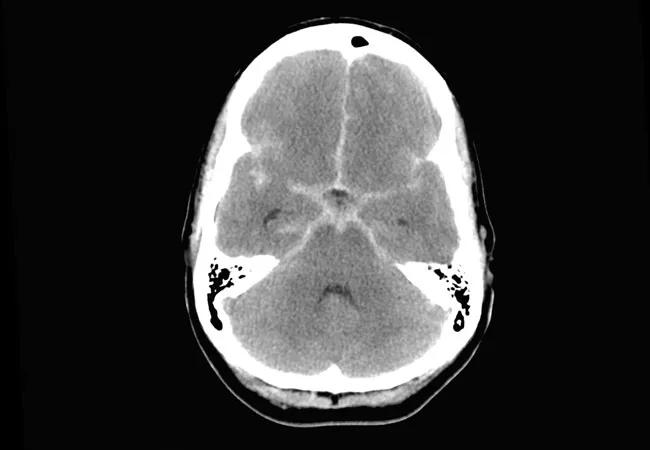 aneurysmal subarachnoid hemorrhage