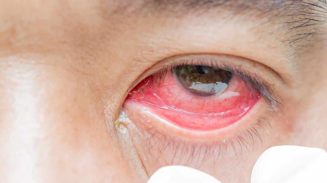 Gloved fingers pulling down lower eye lid of red, inflamed eye