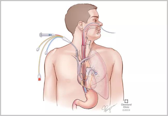 esophageal balloon