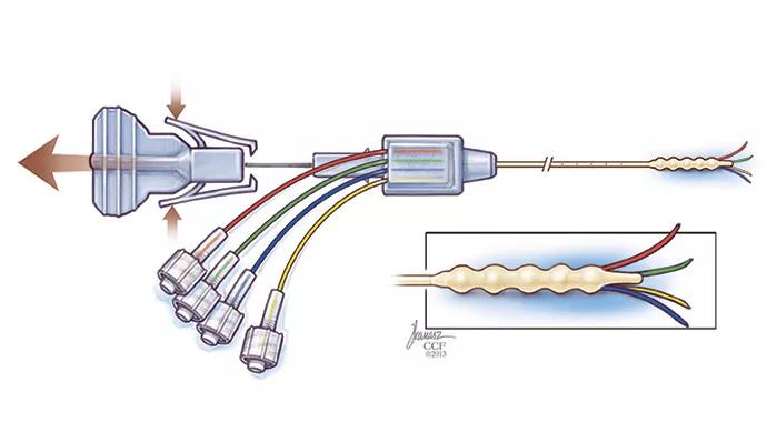 690&#215;380-Vogelbaum-Catheter