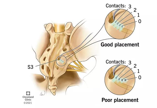 sacral neuromodulation lead