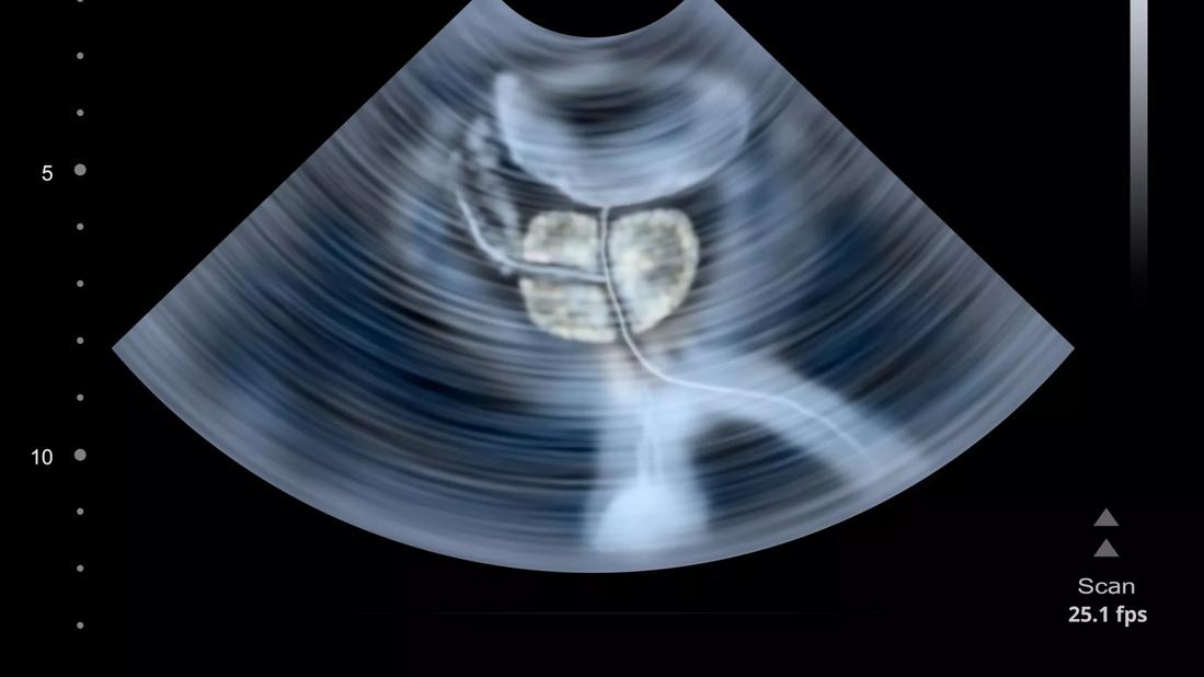 Treatment of Post, High-Intensity-Focused Ultrasound Urethral