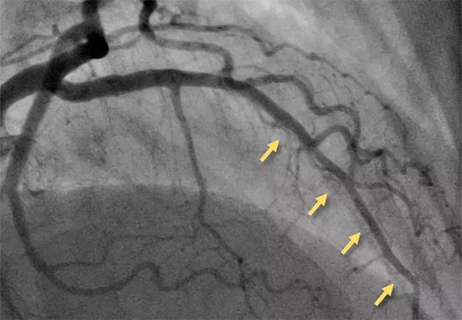 angiogram showing microvascular disease