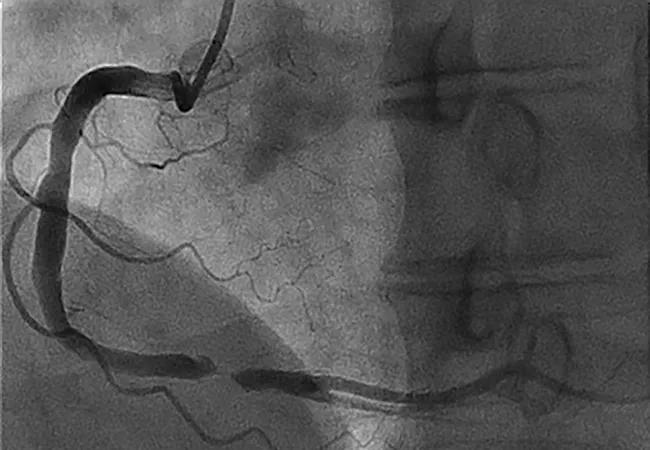 coronary chronic total occlusion-650&#215;450