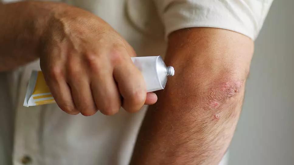 person applying ointment to eczema on arm