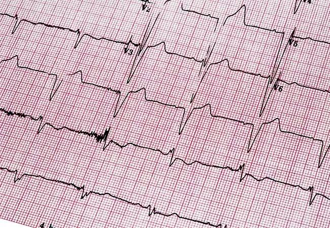 22-HVI-3073818_atrial-fibrillation_650x450