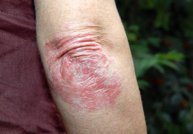 elbow with patch of psoriasis