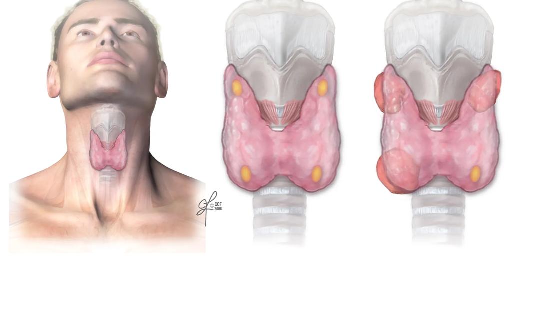 Parathyroid vs. adenoma