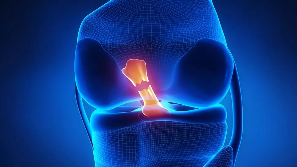 Blue illustration of knee with torn ACL in red