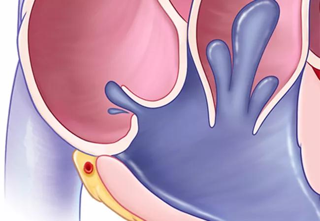 illustration of tricuspid valve regurgitation