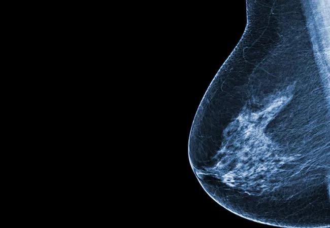 650&#215;450-Breast-Cancer