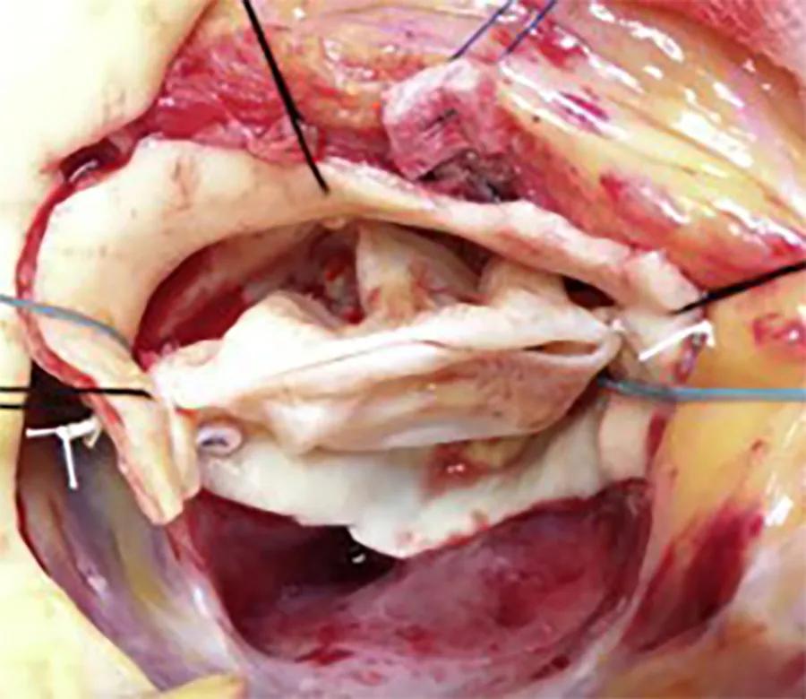 intraoperative photo of a bicuspid valve repair operation