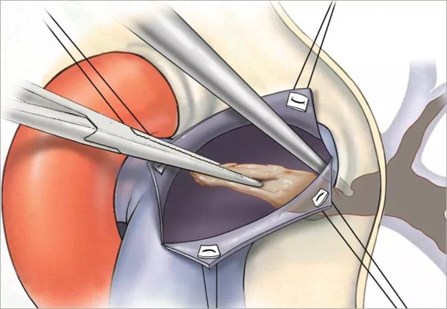 PTE procedure